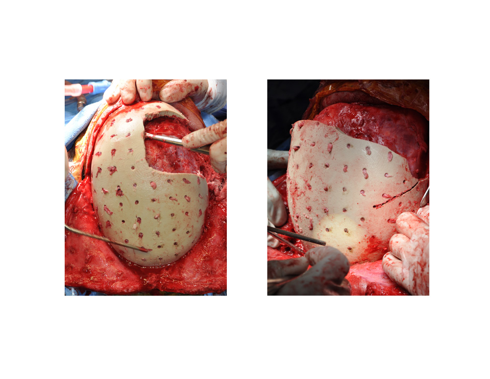 JA-PEKK-Implant-removal-process.jpg