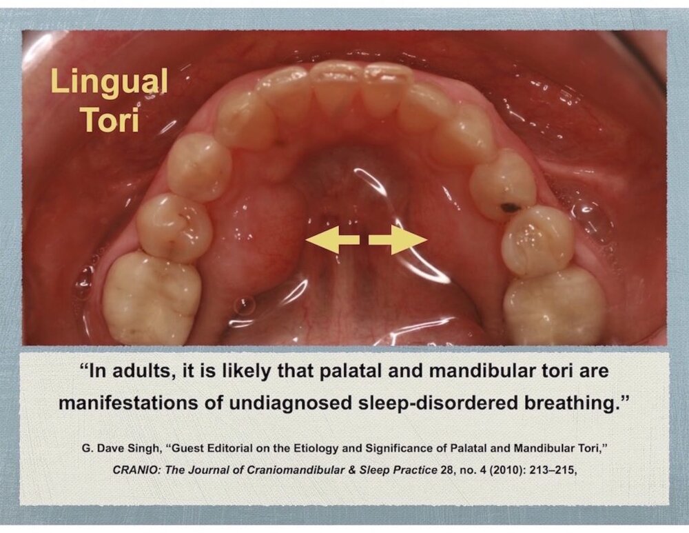 Lingual tori 1024x791