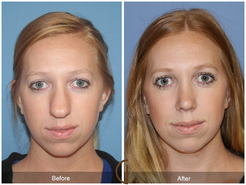 Orange-County-Turbinate-Reduction-Surgery1.jpg