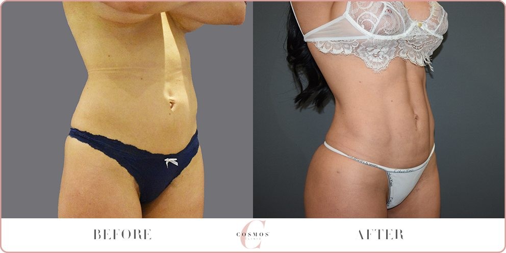 BA-WEB-CC-lipo-high-def-CD.jpg