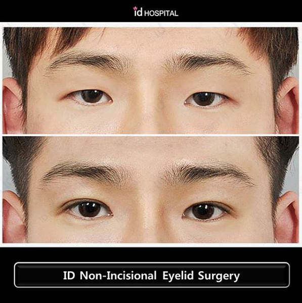 Double eyelid surgery