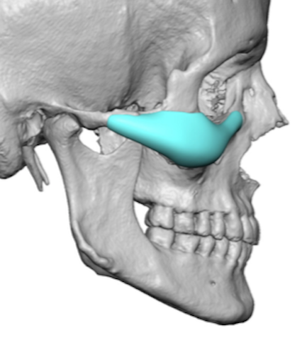 Male-High-Cheekbone-Look-Implant-Style-side-view-3D-CT-scan-Dr-Barry-Eppley-Indianapolis-1.png
