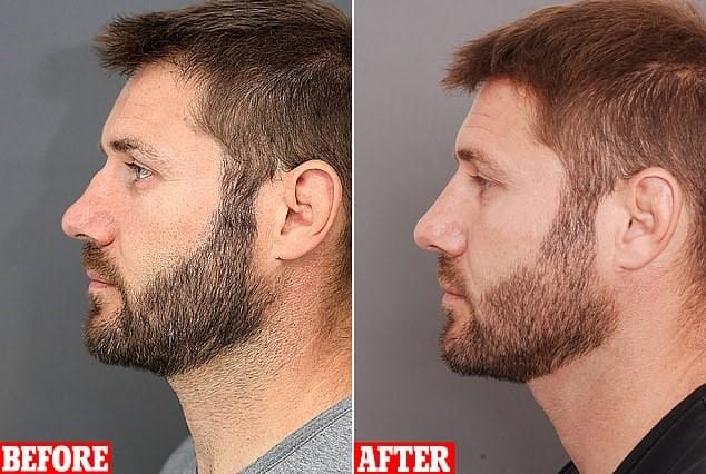 Non-Surgical-Nose-Rhinoplasty.jpg