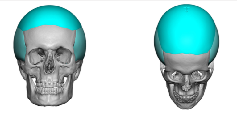 Custom-Skull-and-Temporal-Impllant-Replacements-frnt-view-Dr-Barry-Eppley-Indianapolis-768x372.png