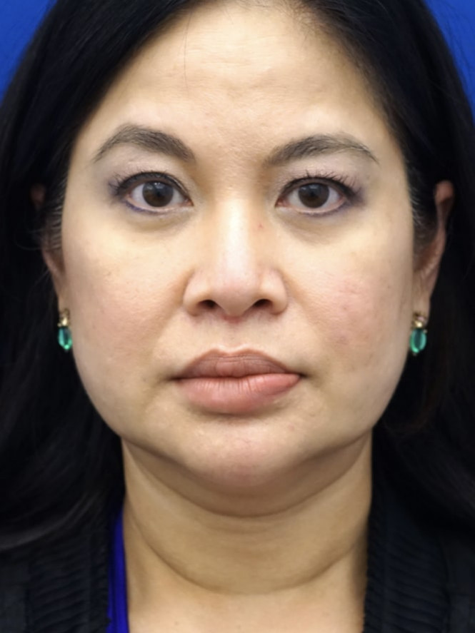4941-imageset_1-before.jpg