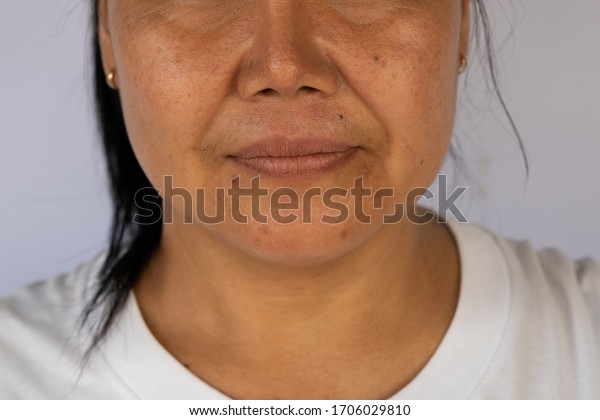 asian-woman-nasolabial-folds-cheeks-600w-1706029810.jpg