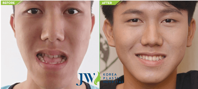 underbite-surgery-6.png