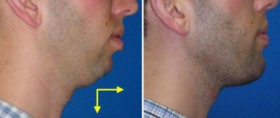 genioplasty-400w.jpg