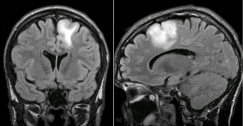 inflglioma2.jpg