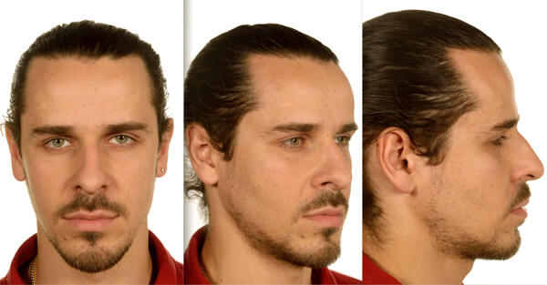 pmfaam20_mid-facial_implants_figures-3.jpg