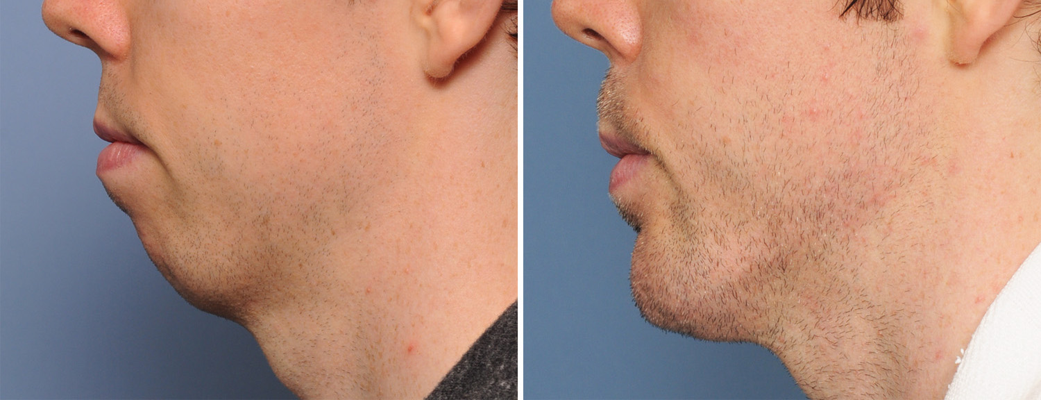 Sliding-Genioplasty-withj-Chin-Implant-result-side-view-Dr-Barry-Eppley-Indianapolis.jpg