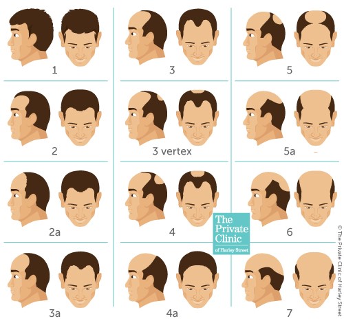 what-is-norwood-hair-loss-scale-stages.jpg