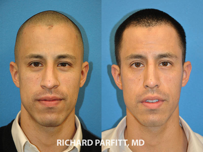 rhinoplasty-nose-job-WI-patient-231.jpg
