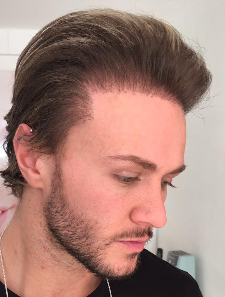 natural-hairline-bad-celebrity-hair-transplant-png.105843