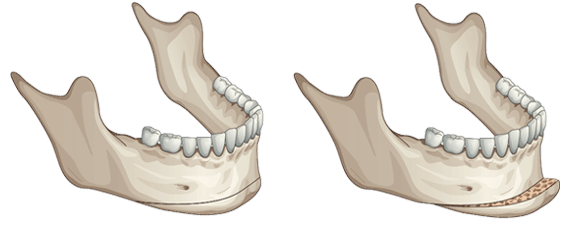 sliding-genioplasty.png