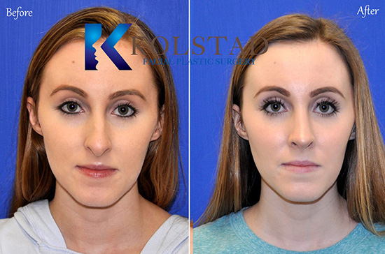 rhinoplasty-san-diego-209-copy.jpg