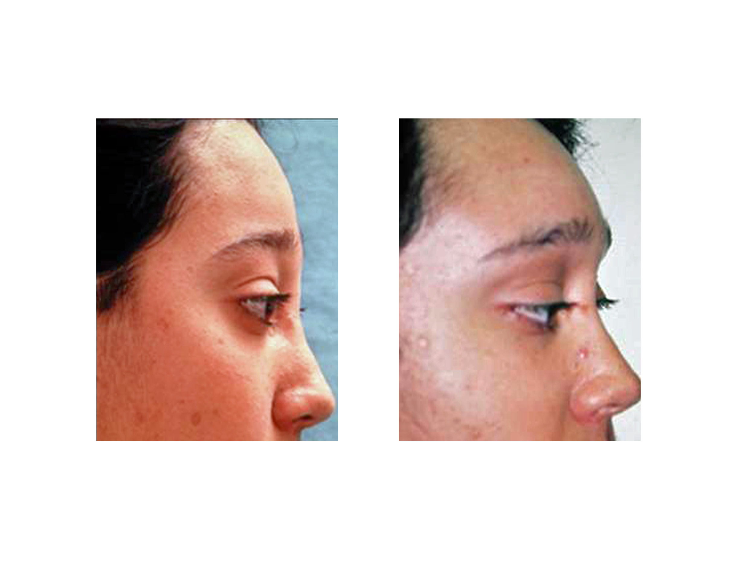 Options in Brow Bone and Forehead Augmentation - Explore Plastic Surgery