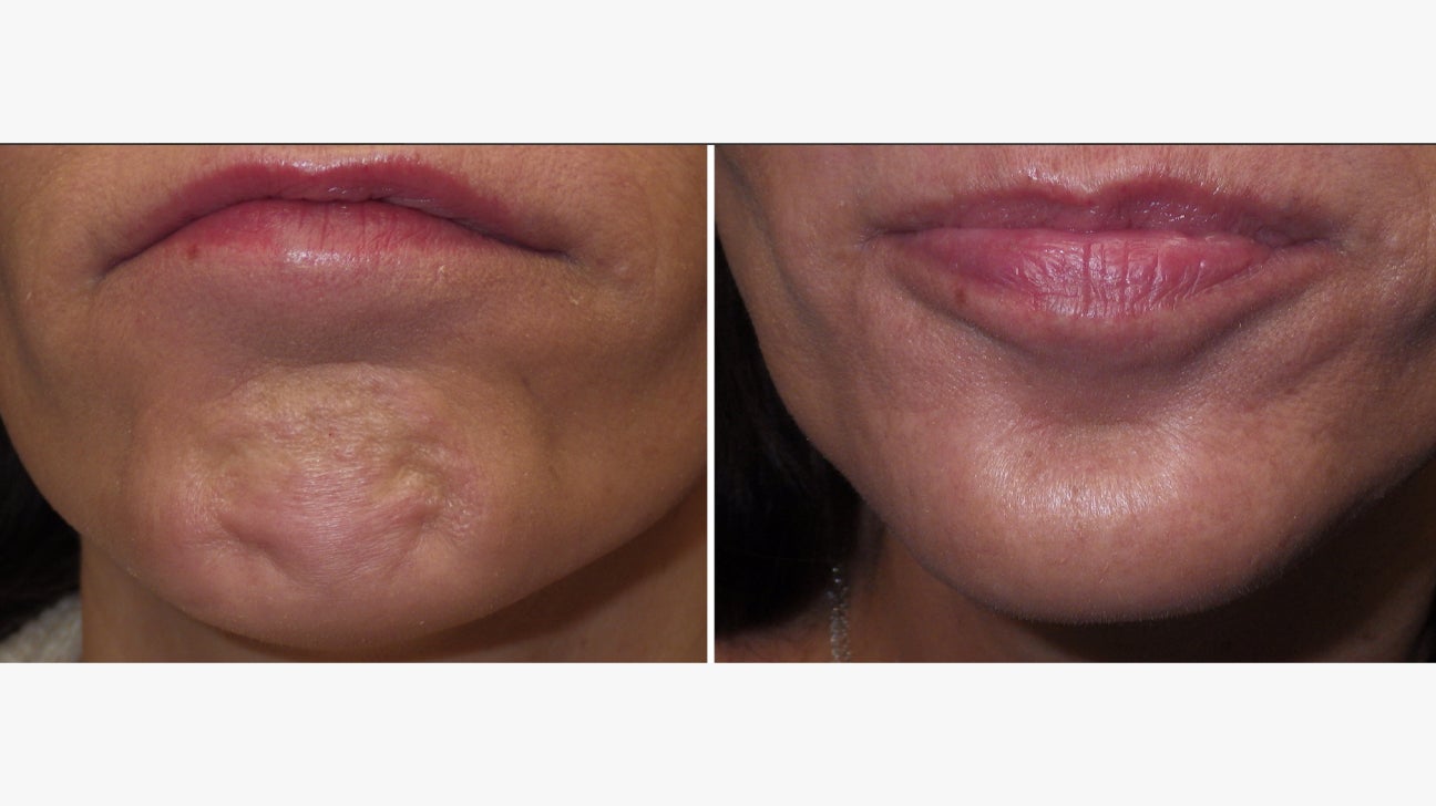 chin-Botox-1296x728-slide1.jpg