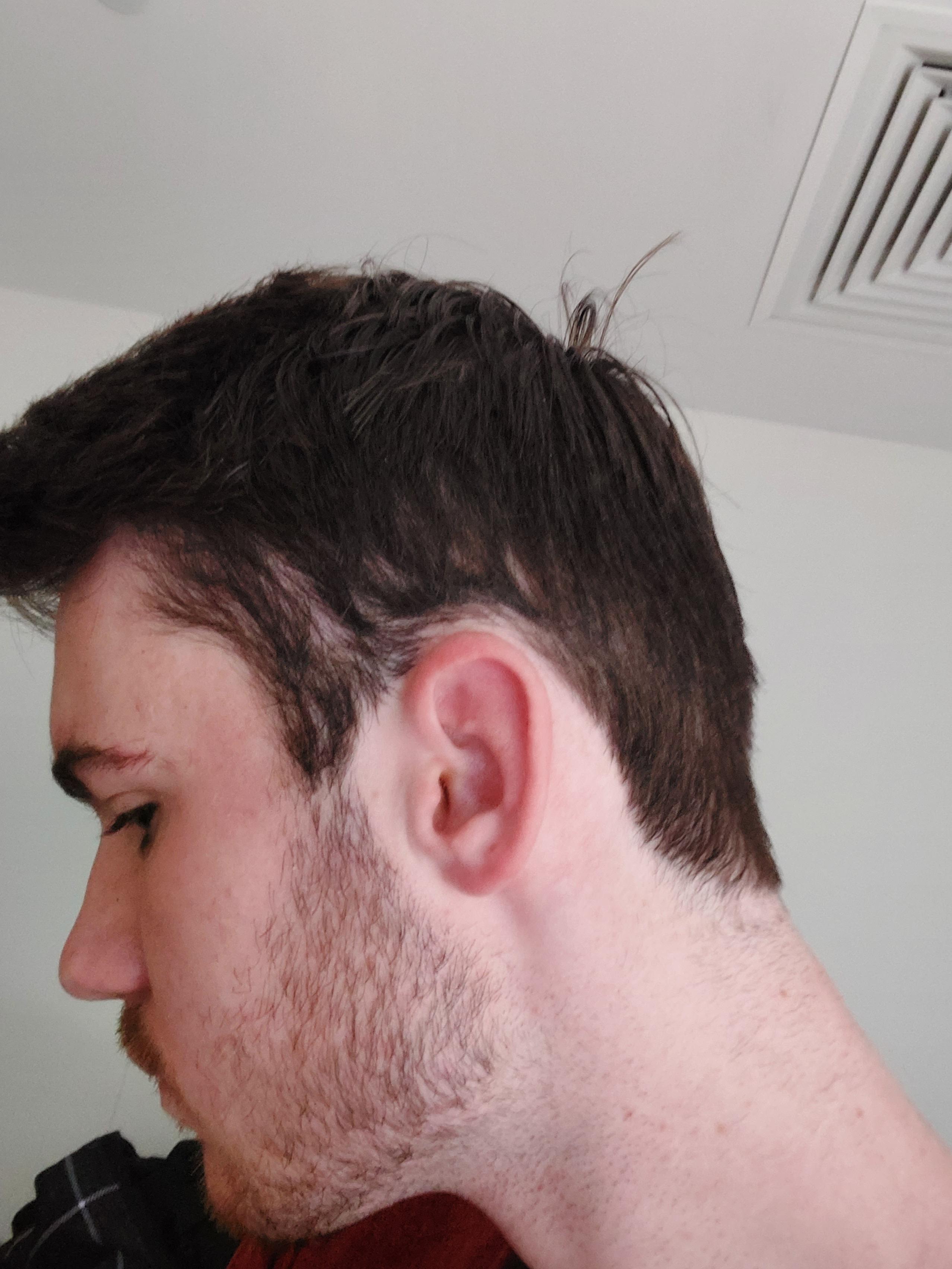 Is this retrograde alopecia or dupa (hopefully not the second one) :  r/HairlossResearch