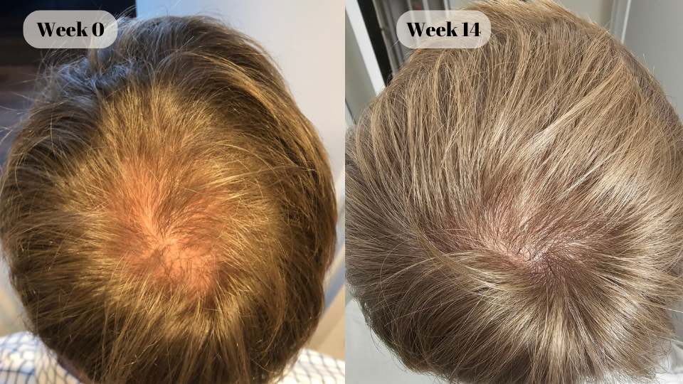 dutasteride-before-and-after-5.png