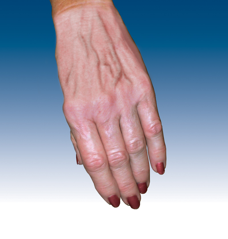 Got Time On Your Hands? Ugly hand veins? – Morrison Vein's Blog