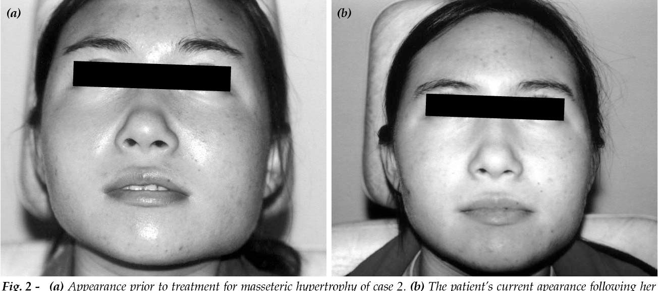 Treatment of unilateral masseter hypertrophy with botulinum toxin in two  cases. | Semantic Scholar