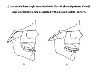 cranial-base-angle-in-relation-to-malocclusion-18-320.jpg