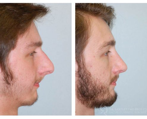 rhinoplasty27-495x400.jpg