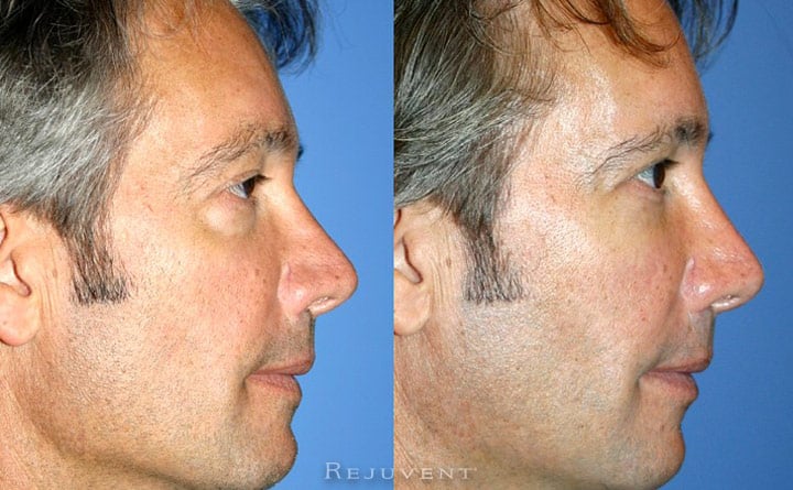 filler-eyes2-720x445_rej.jpg