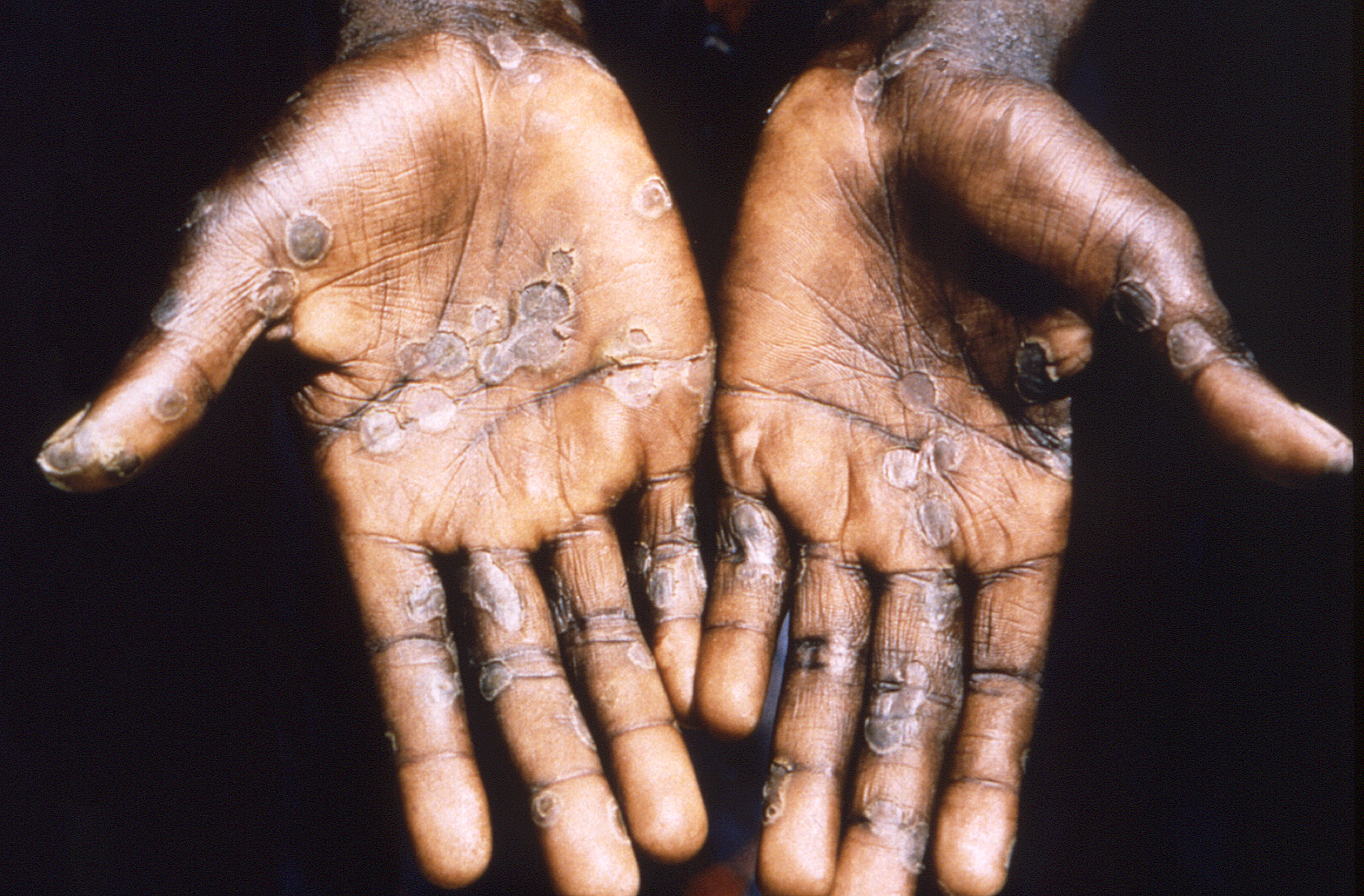 Monkeypox_CDC.jpg