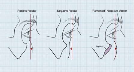 Prominent Eyes, Negative Vector, Round Eyes and Infraorbital Rim Implants –  World Renowned Bespoke/Cosmetic Plastic Surgeon-Boston, Dr. Michael  Yaremchuk