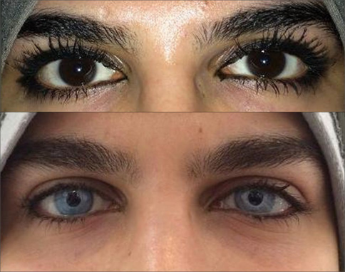 Surgical Techniques for Cosmetic Eye Color Change: A Narrative Review -  Doctor Jorge Alió