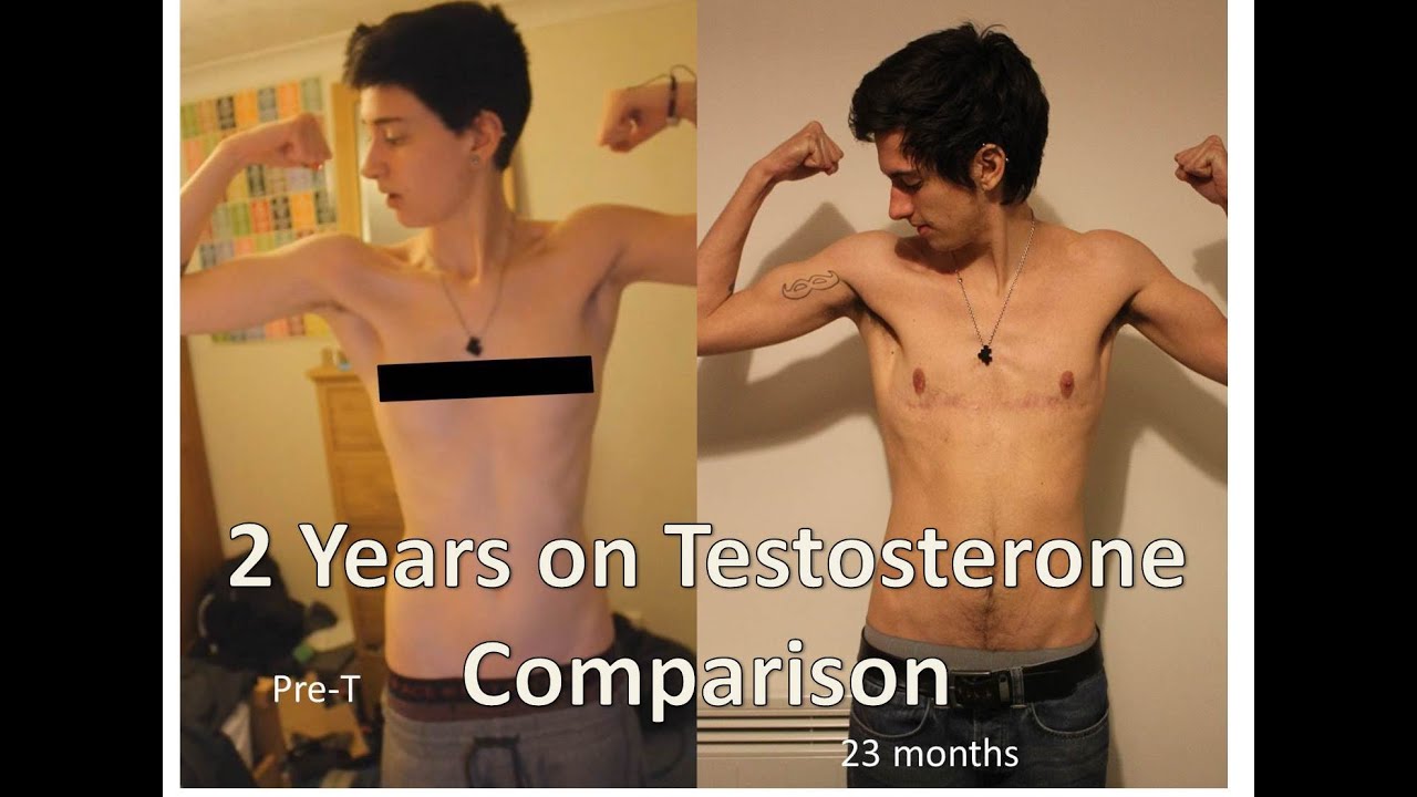 FTM nearly 2 years on Testosterone comparison - YouTube