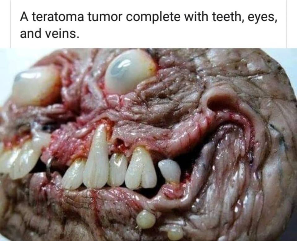 Tumor-with-eyes-and-teeth.jpg