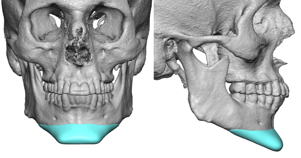 www.eppleycustomfacialimplants.com