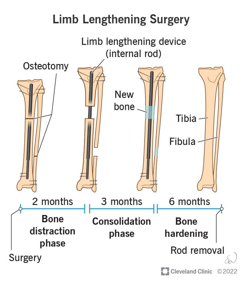 24316-limb-lengthening-surgery.jpg