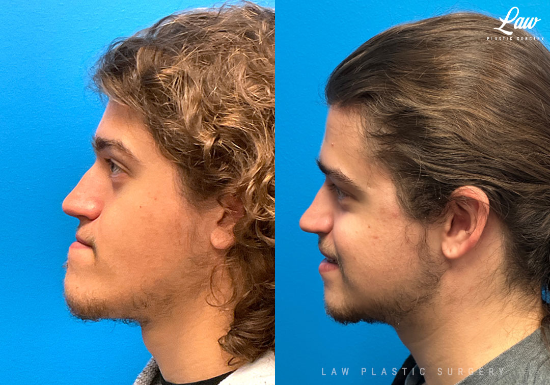 Jaw Surgery Before and After Photo. Surgery performed in Dallas, TX at Law Plastic Surgery.