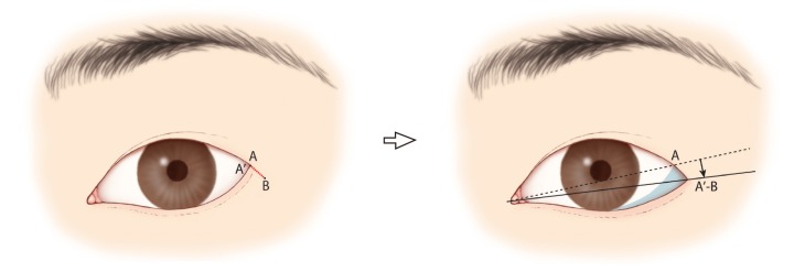 Cosmetic Lateral Canthoplasty: Lateral Canthoplasty to Lengthen the Lateral  Canthal Angle and Correct the Outer Tail of the Eye - PMC