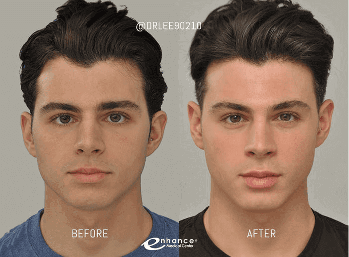 cheek_reduction_results_male.png