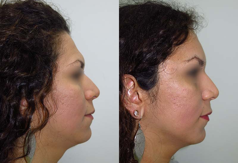 forehead-facial-feminization-before-after.jpg