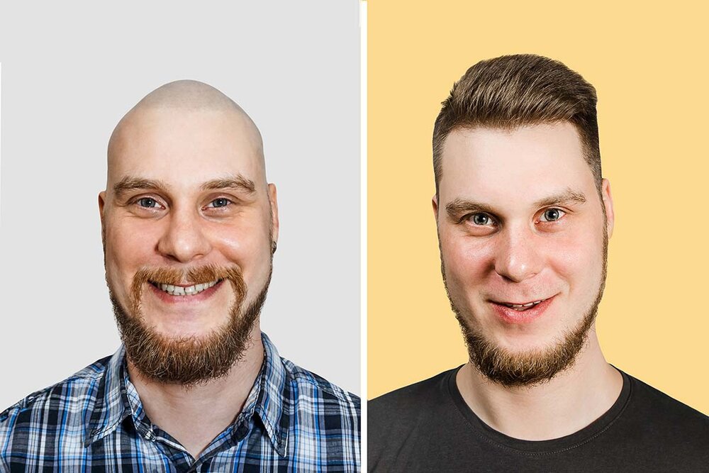 Hair-Transplant-Toronto-01.jpg