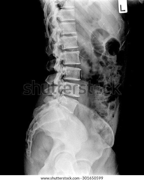 xray-pelvis-spinal-column-side-600w-301650599.jpg