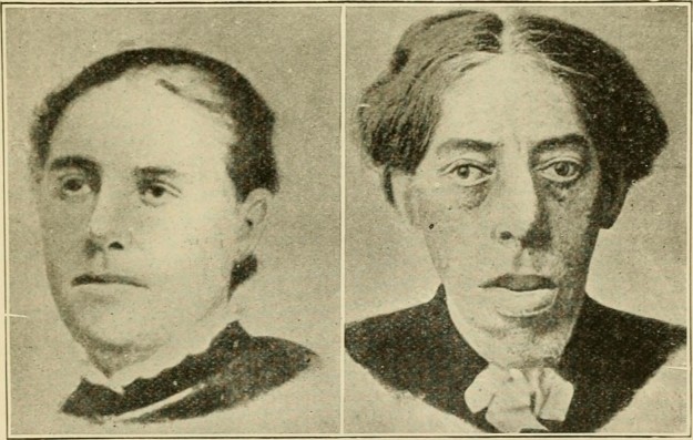Acromegaly.jpg