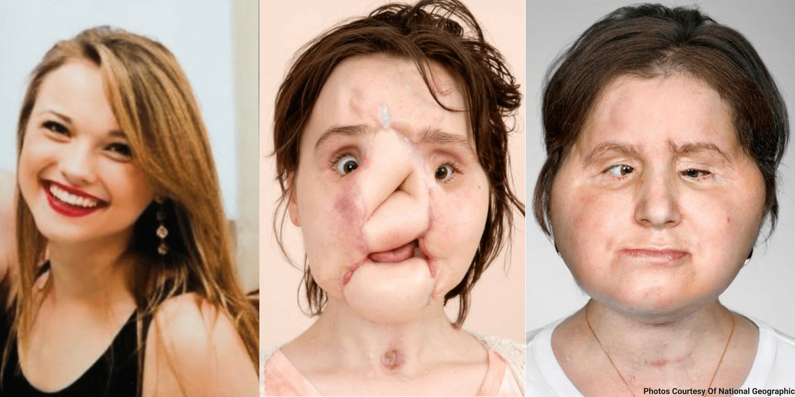 LCCR-Face-Transplant-Suicide-Article.png
