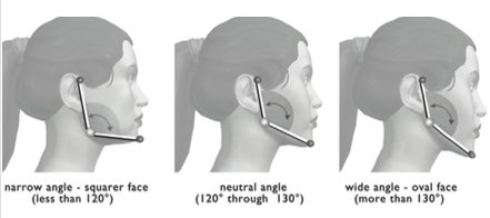 Steep mandibular plane angles?