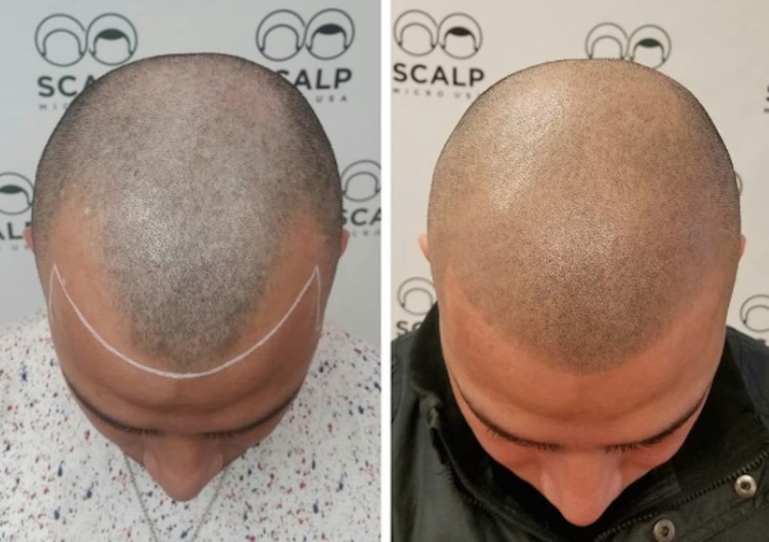 Tattoing-Bald.jpg