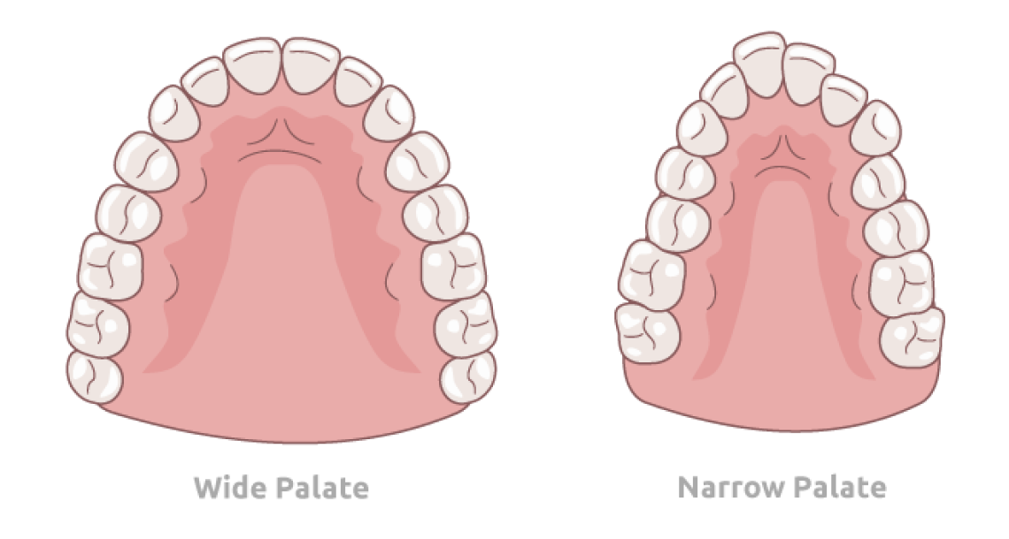 Narrow Palate and Sleep Apnea: What You Need to Know