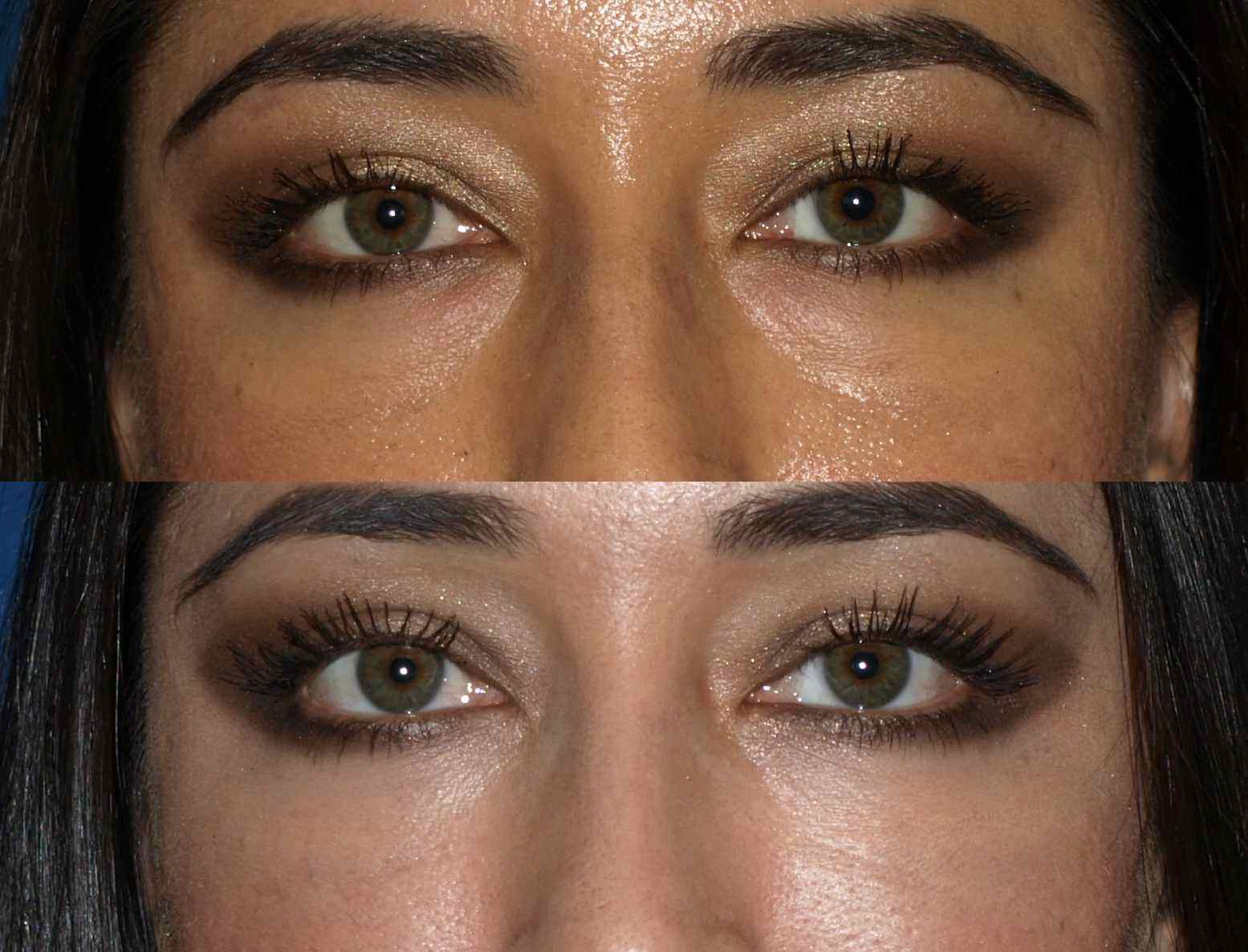 eyes-before-and-after-vertical.jpg