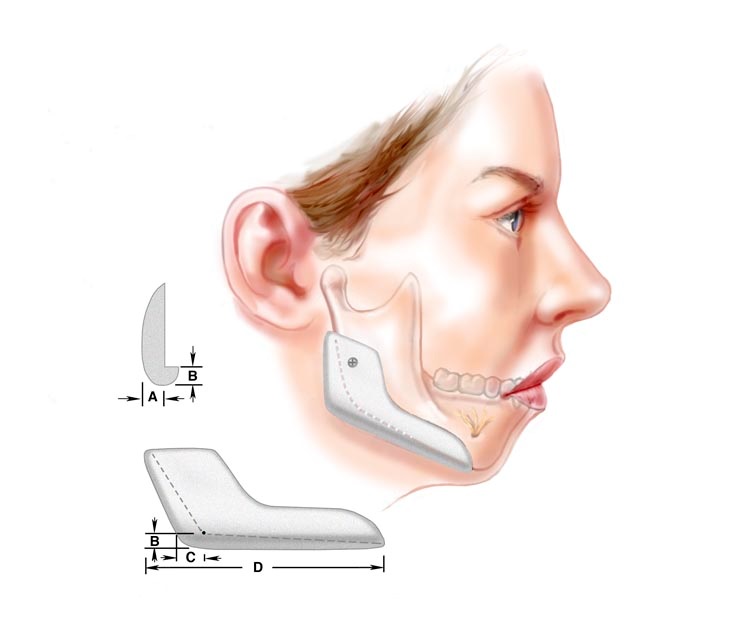 chin-implant1.jpg