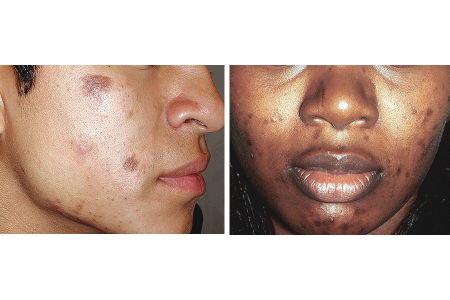 acne-scars-symptoms-pih-comparison.png